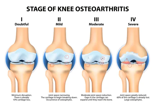 stem cell therapy Osteoarthritis