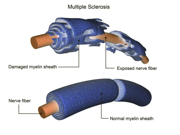 Stem Cell Therapy multiple sclerosis