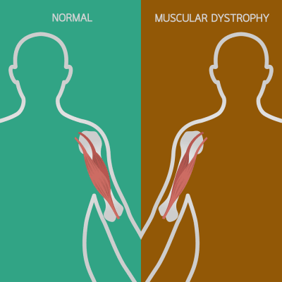 stem cell therapy for muscular dystrophy