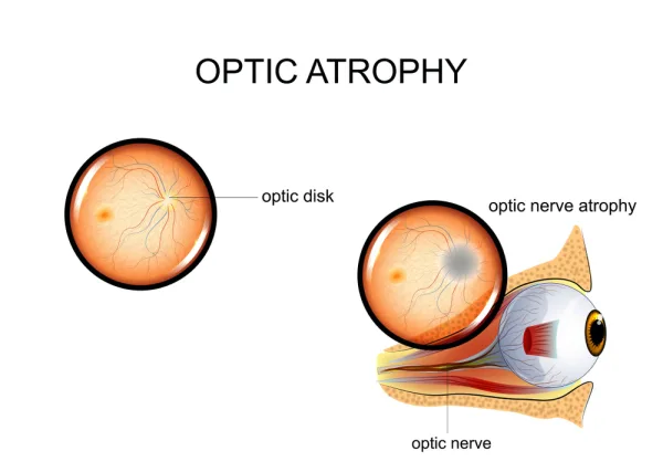 Stem Cell Therapy for Optic nerve
