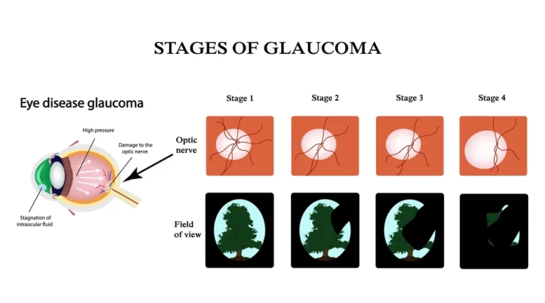 stages of glaucoma