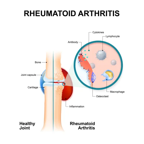 stem cell therapy rheumatoid arthritis