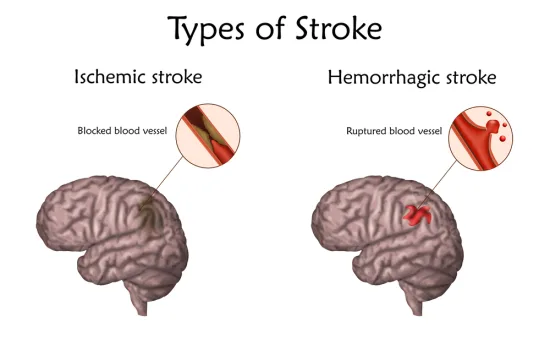 types of stroke